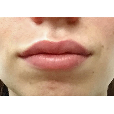 After Lip Filler