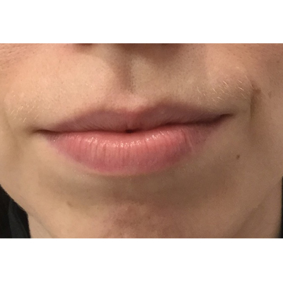 Before Lip Filler