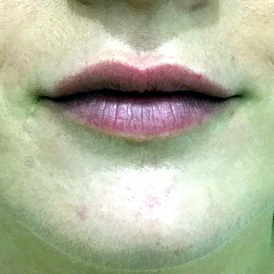 After Lip Filler