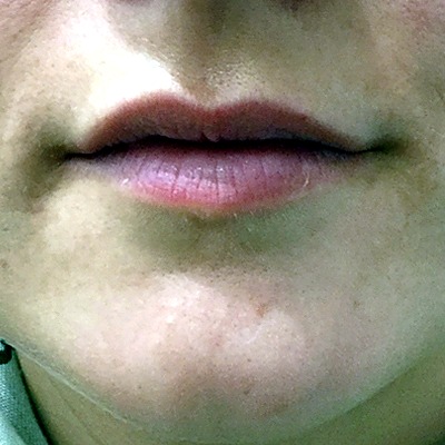 Before Lip Filler