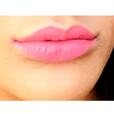After Lip Filler