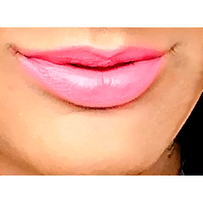 Before Lip Filler